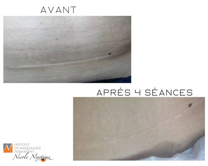 Soin de microneedling des cicatrices du ventre afin de les diminuer