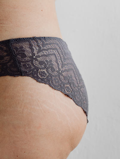 Correction vergetures sur les fesses