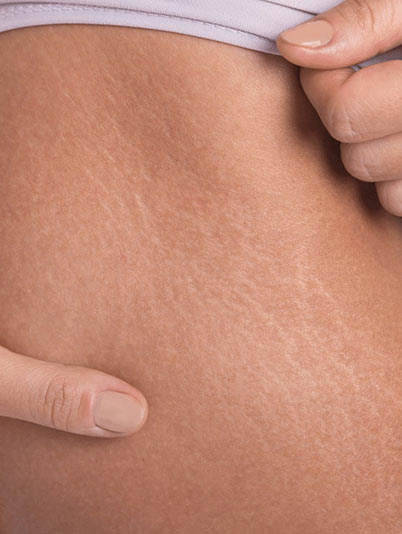 Correction vergetures