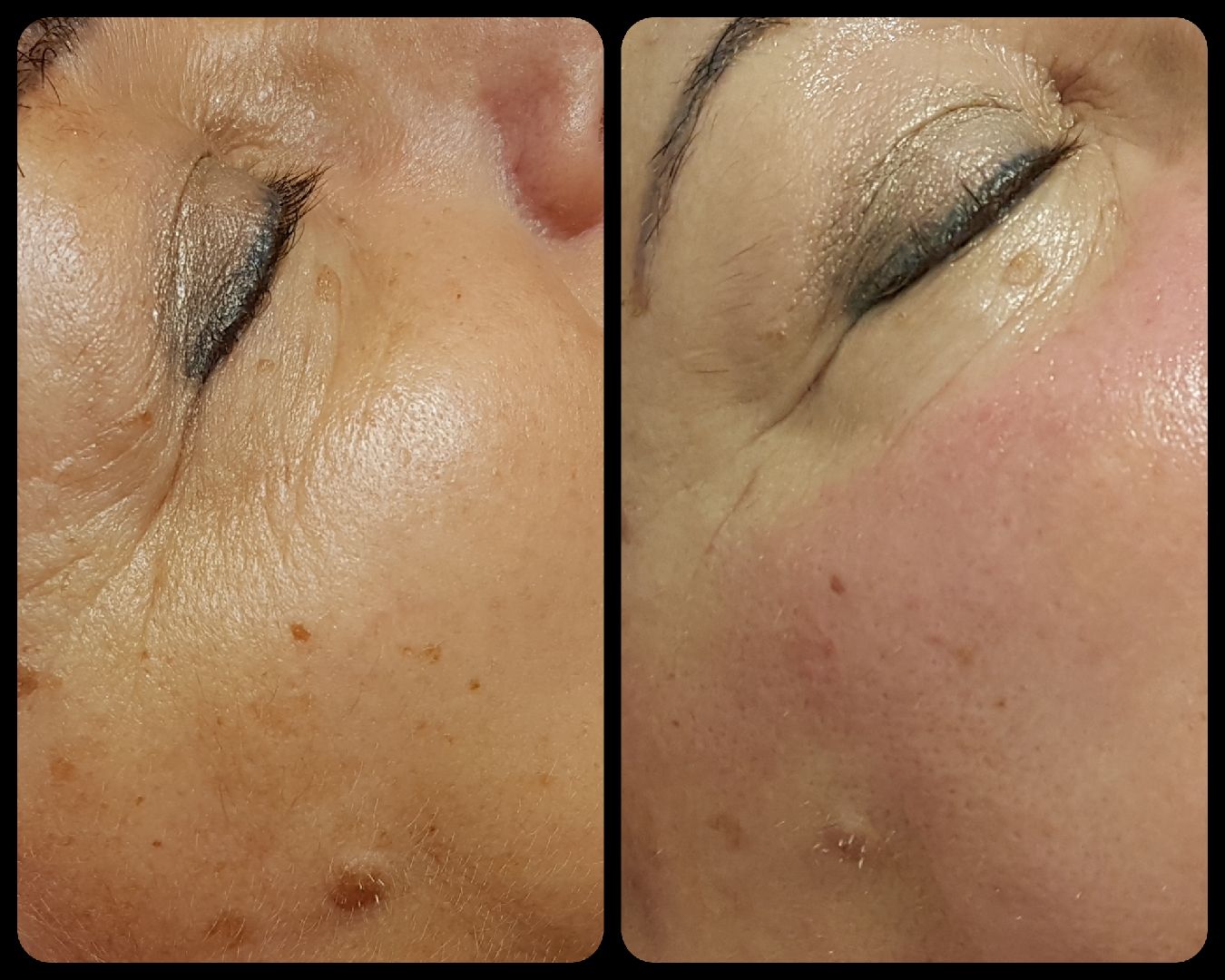 Mésothérapie avant-après