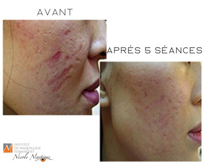 Scéance de microneedling pour le visage, problème acné