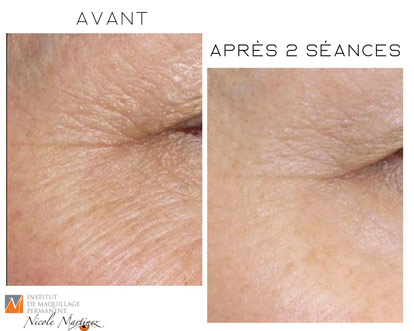 Soin du visage anti-âge, réduction des rides