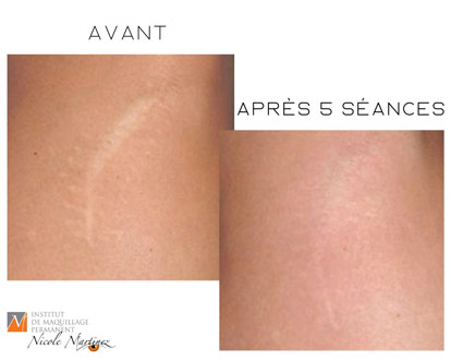 Soin de microneedling des cicatrices après d'opération afin de les diminuer