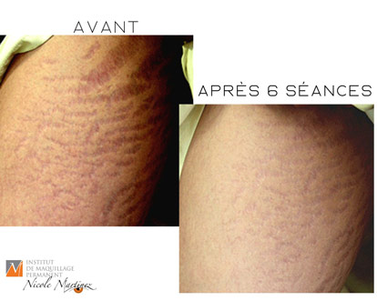 Soin de microneedling des vergetures afin de les diminuer