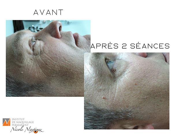 Microneedling - avant / après