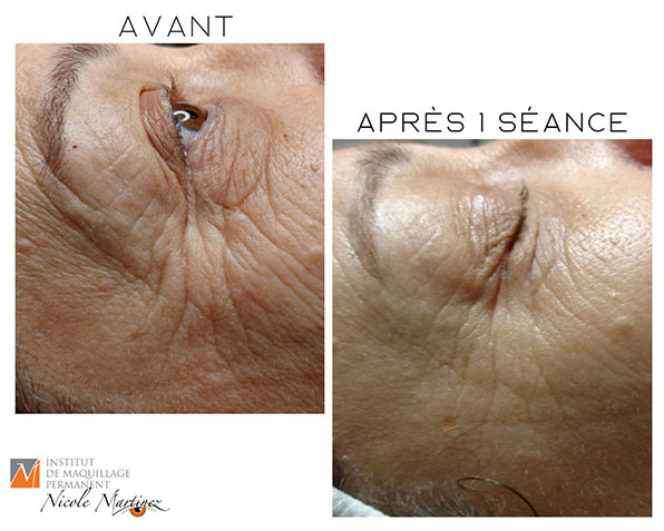 Microneedling - avant / après