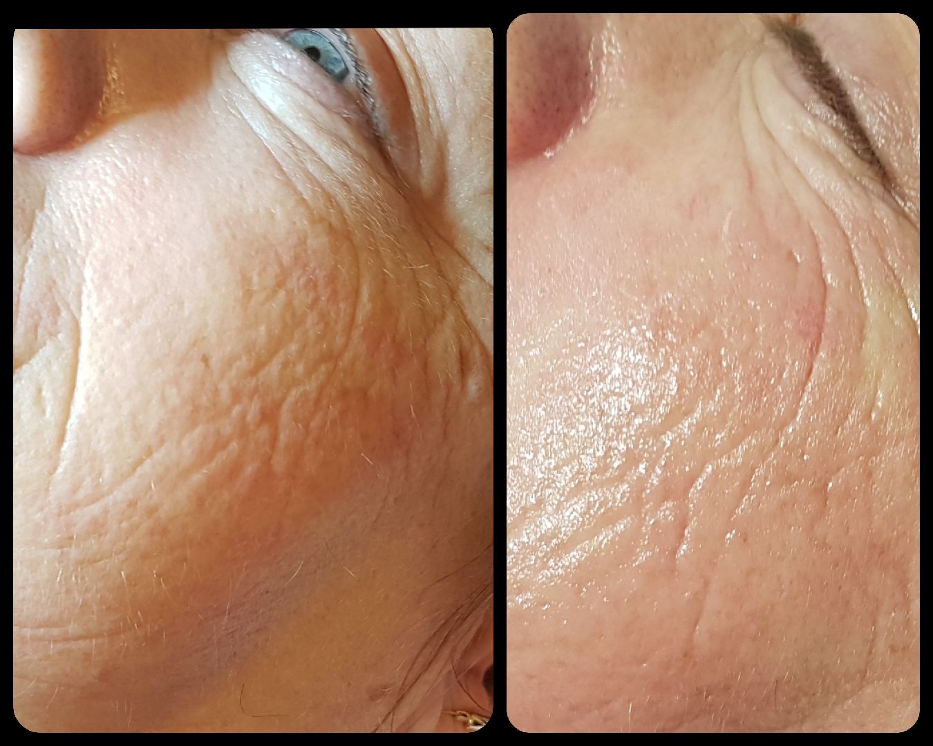 Microneedling avant-après