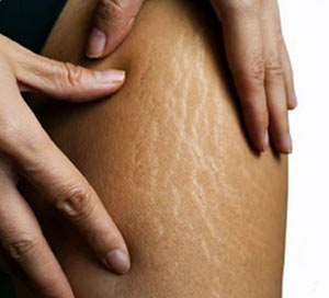 Micropigmentation correctrice cuisse